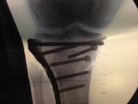 Fractura de meseta tibial Schatzker tipo VI — imagen 3