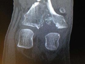 Fractura de meseta tibial Schatzker tipo VI — imagen 1