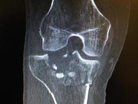 Fractura de meseta tibial Schatzker tipo VI — imagen 2