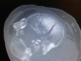 Fractura de meseta tibial Schatzker tipo VI — imagen 4