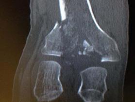 Fractura de meseta tibial Schatzker tipo VI — imagen 5