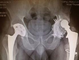Rescate de prótesis de cadera — imagen 1